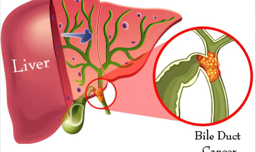 Bile Duct Cancer Market: Rising Cases and Advancements Offer Promising Growth Opportunities