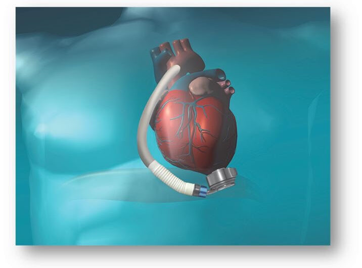 Cardiac Assist Devices Market: Increasing Prevalence of Cardiovascular Disorders Driving Market Growth