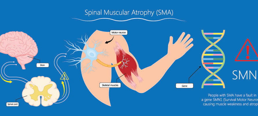 Future Prospects and Growth Analysis of the Spinal Muscular Atrophy Market