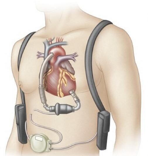 Cardiac Assist Devices is the largest segment driving the growth of the Cardiac Assist Devices Market