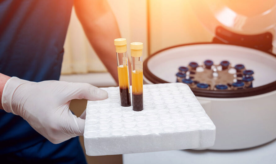 The Rise Of Platelet Rich Plasma as an Adjuvant Therapy is Anticipated to Openup the New Avenue for Platelet Rich Plasma Market