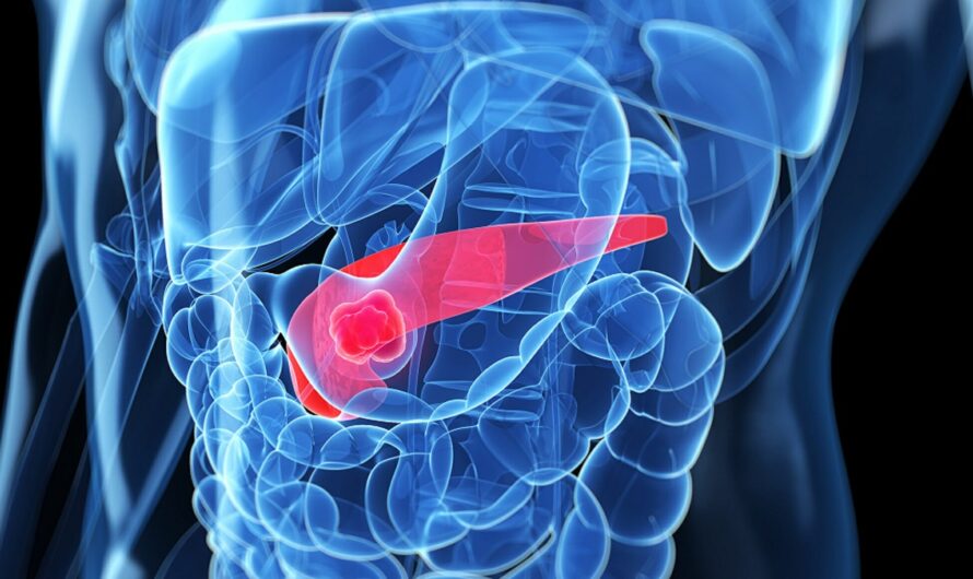 Promising Pancreatic Cancer Organoids Developed for Anticancer Drug Screening