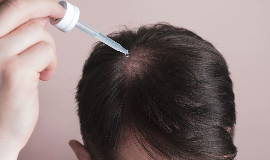 The Global Minoxidil Market is Projected to driven by growing Alopecia Cases