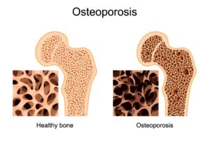 Osteoporosis Treatment Market