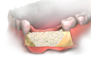 Dental Membrane And Bone Graft Substitute Market1