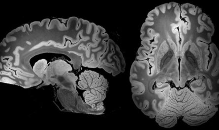 MRI and AI Technology: Streamlining Pediatric Brain Tumor Diagnosis with Shorter Wait Times
